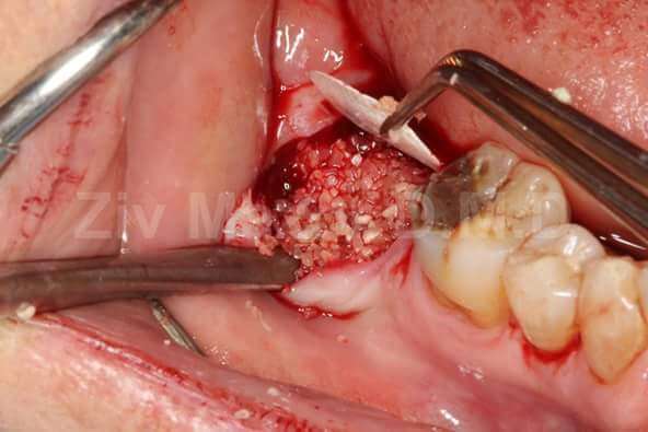 Autogenous Tooth Grafting – 18 Month Follow Up | Dental Case of the Day
