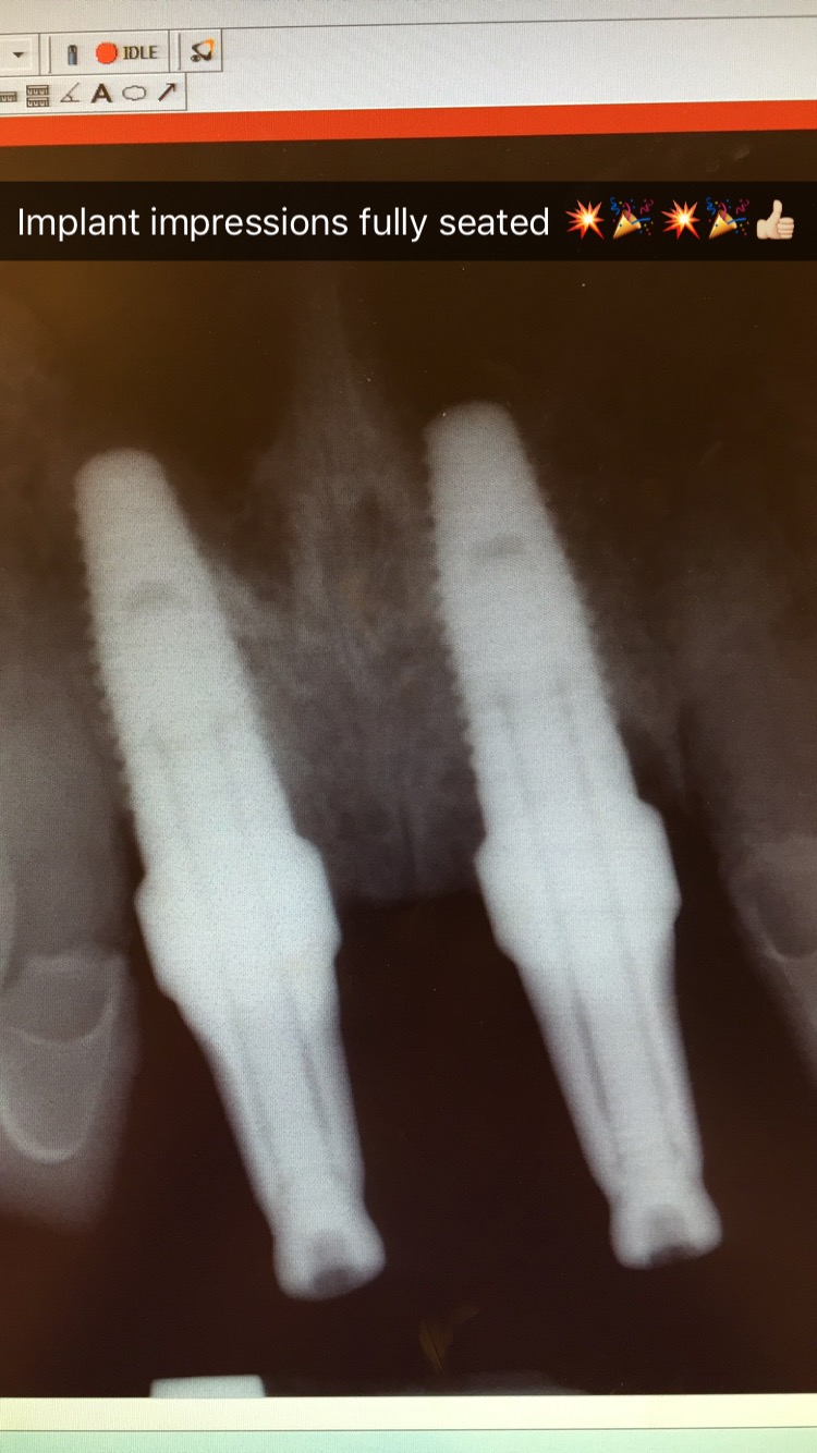 Importance of Radiographs to Verify Accurate Interface of Abutment to